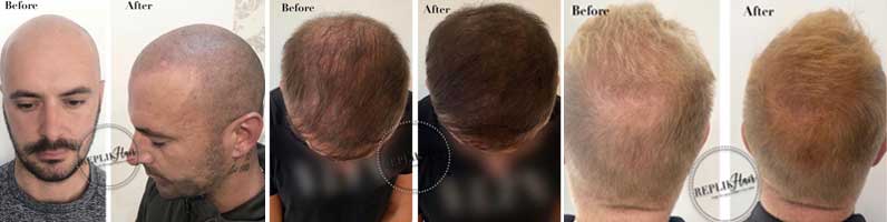 mens scalp micropigmentation